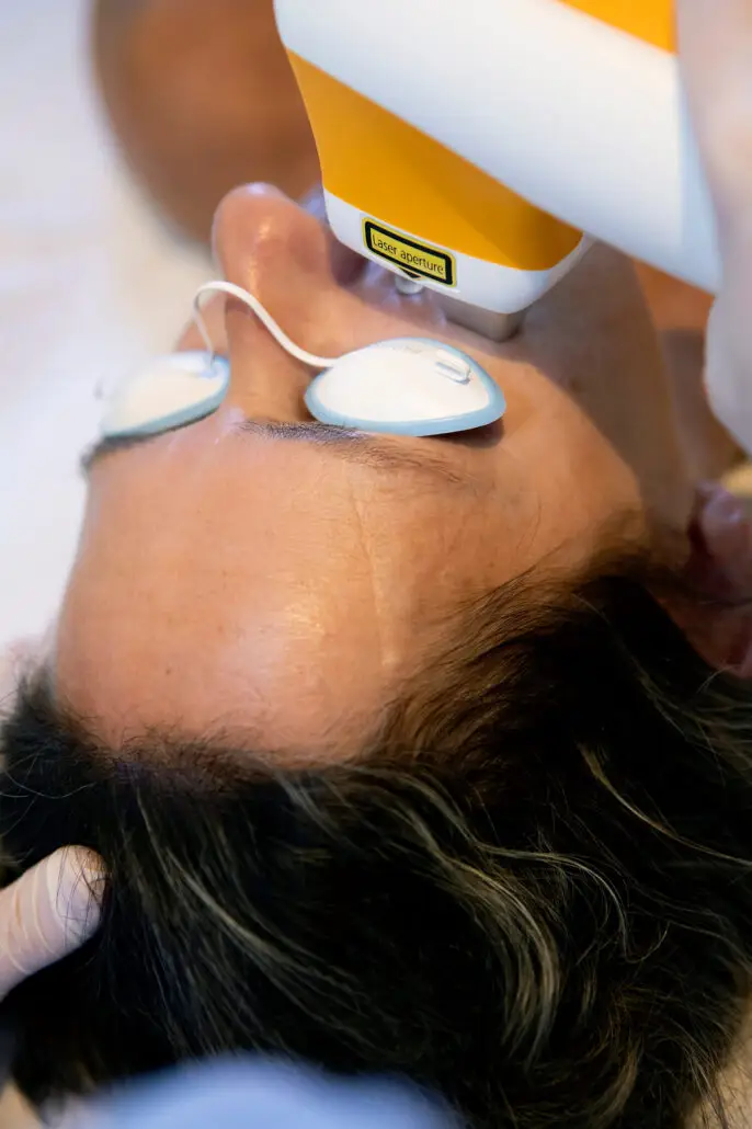 Laser acne - Kik Your Skin
